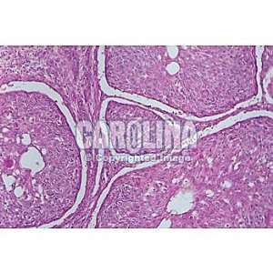 Human Carcinoma of Esophagus, sec. 7 um, H&E:  Industrial 