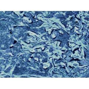  Micrograph Skin Cancer Malignant Epidermis Photographic 