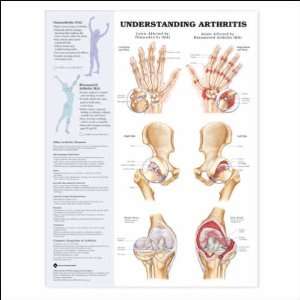  Understanding Arthritis Anatomical Chart 20 X 26 Health 
